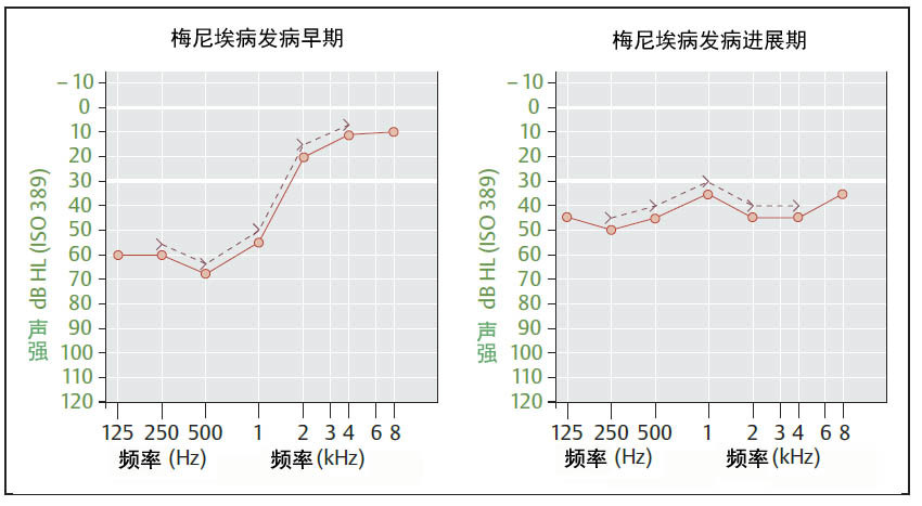 梅尼埃病听力图.jpg