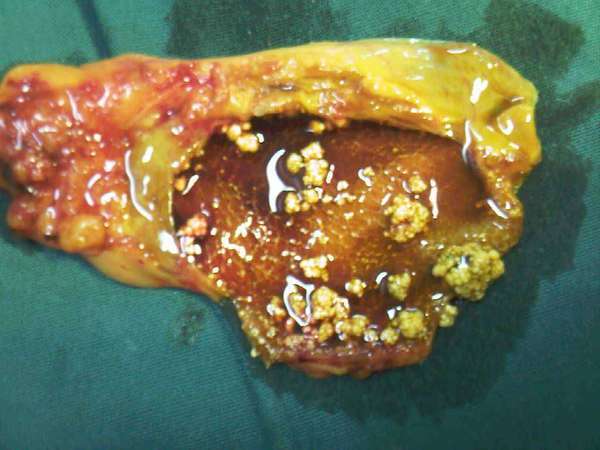 从明星张一山的病说起——谈谈胆囊息肉可怕吗?有哪些注意事项.