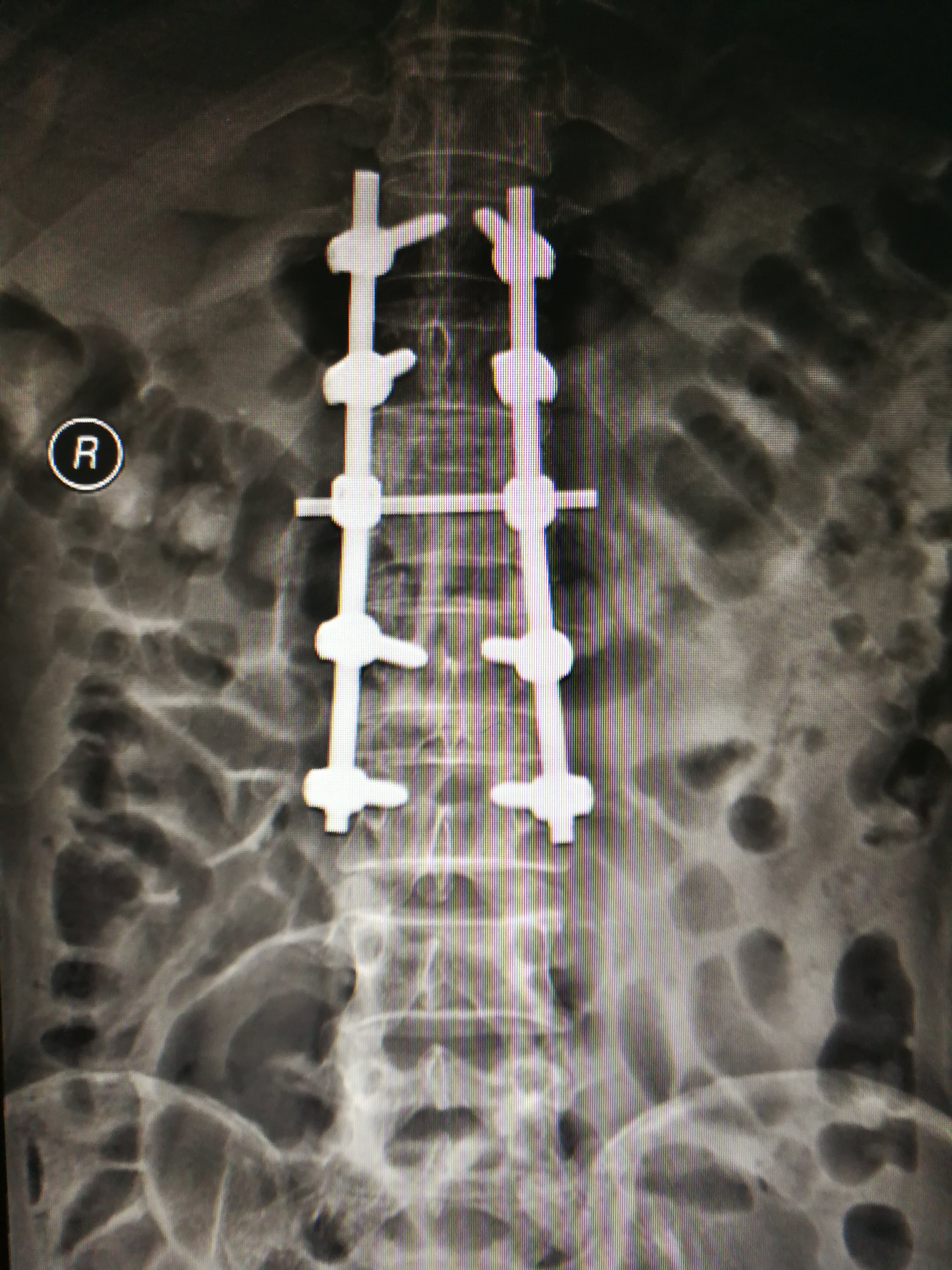 胸腰椎爆裂性骨折并不全瘫手术治疗