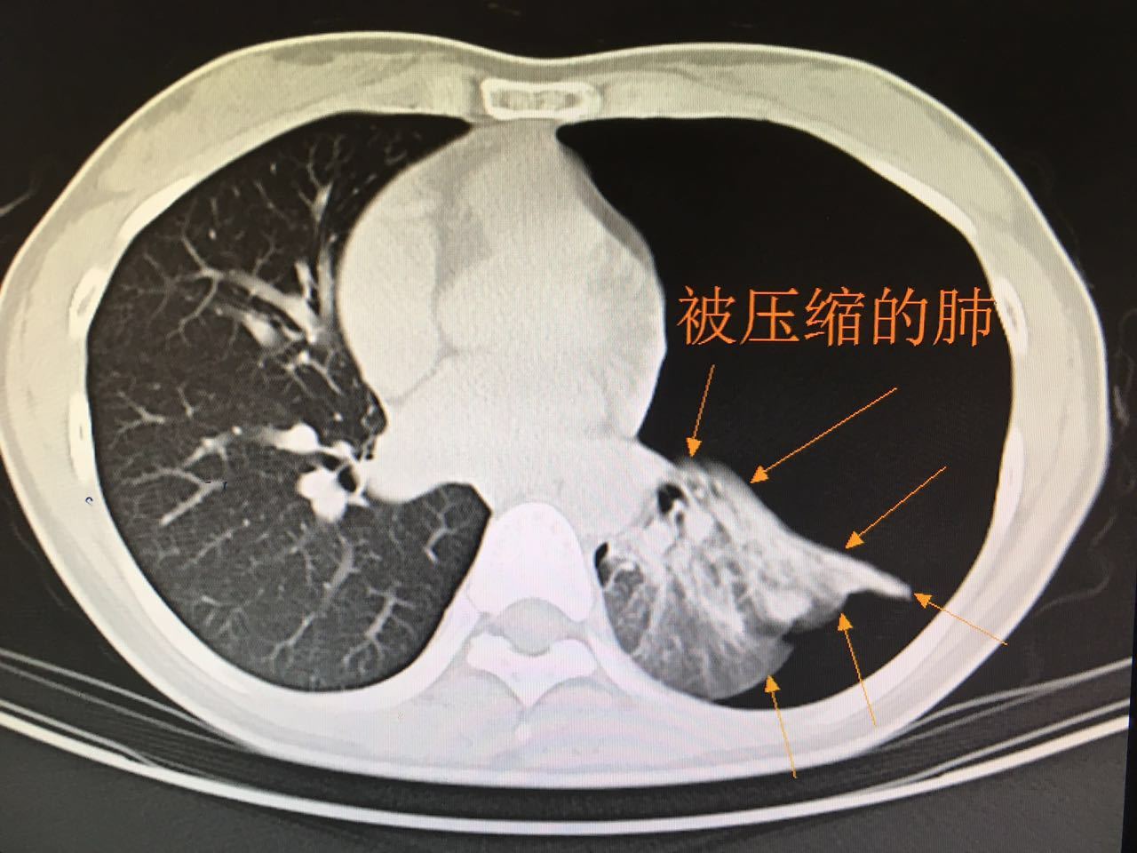 什么是气胸有哪些症状
