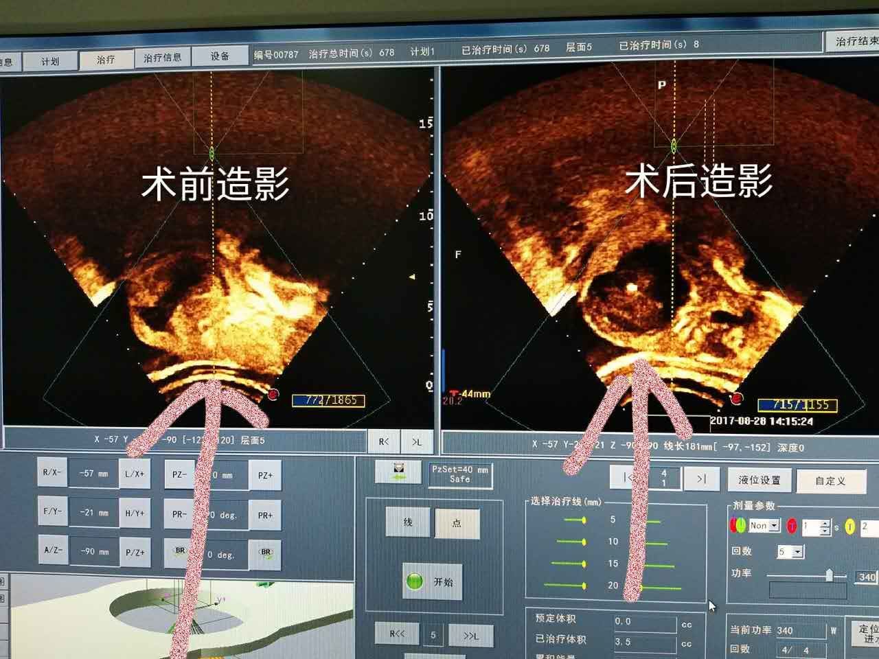 海扶病历分享:备孕遭遇多发性子宫肌瘤