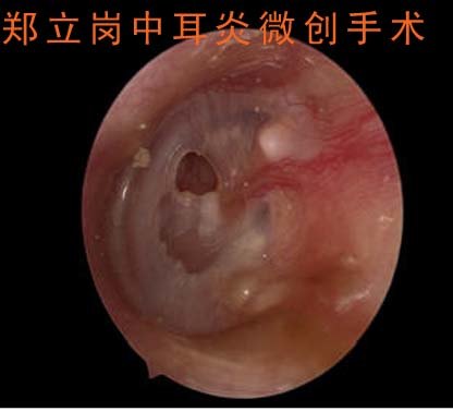 前言:中耳炎微創手術是目前治療慢性化膿性中耳炎及膽脂瘤型中耳炎最