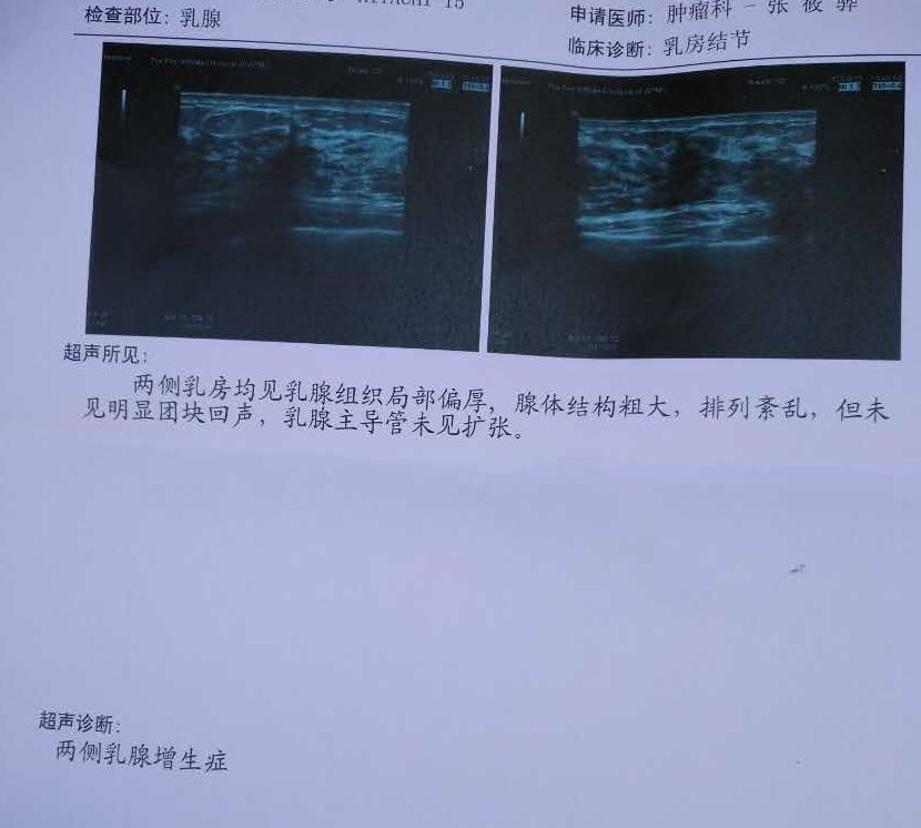 典型病例1双侧乳腺结节biradsiva级一例