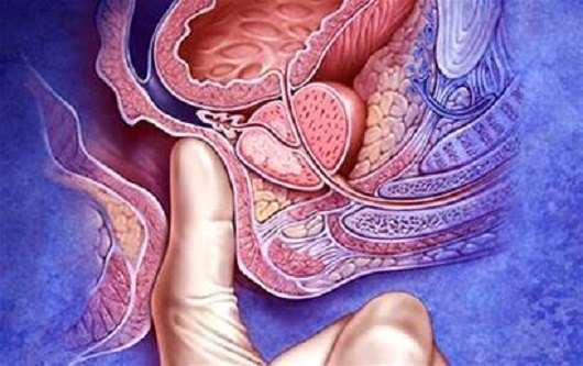 肛门癌早期症状图片图片