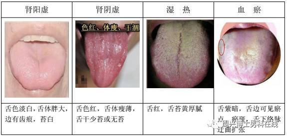 下面为大家介绍几种常见证型的舌苔情况