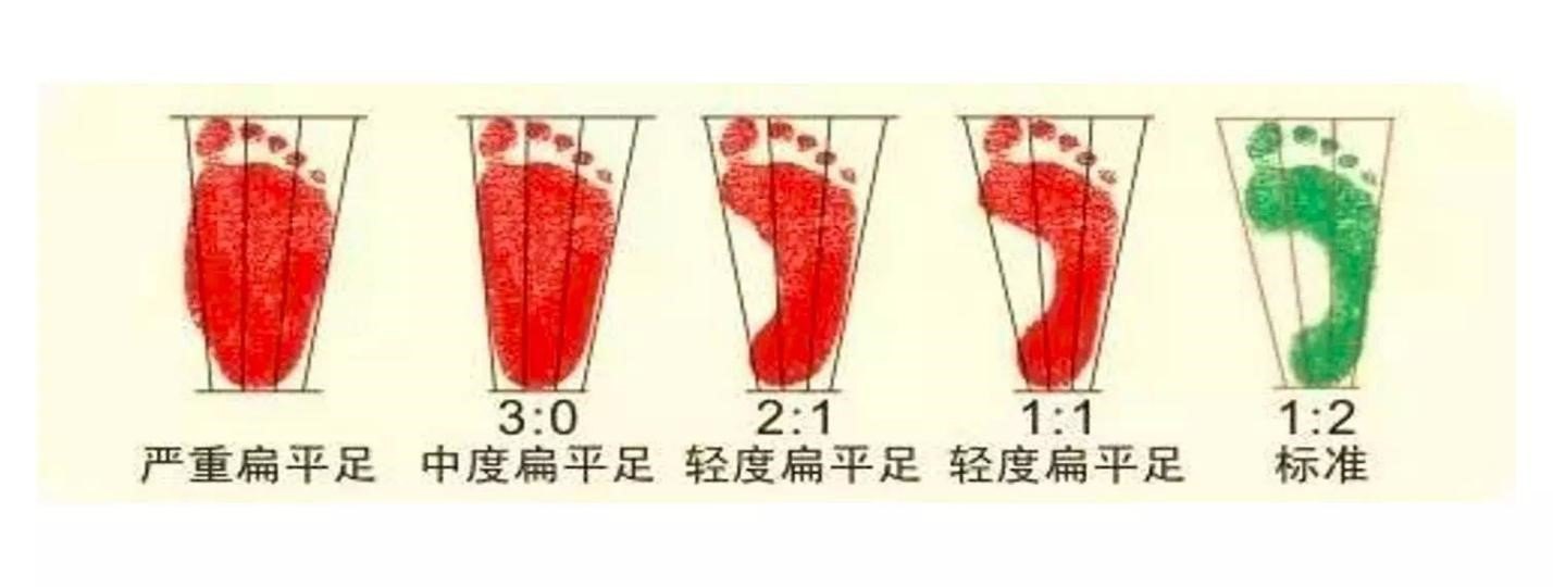 空白區寬度與足印最窄區寬度(實心) 之比是 2:1;輕度扁平足的比值為 1