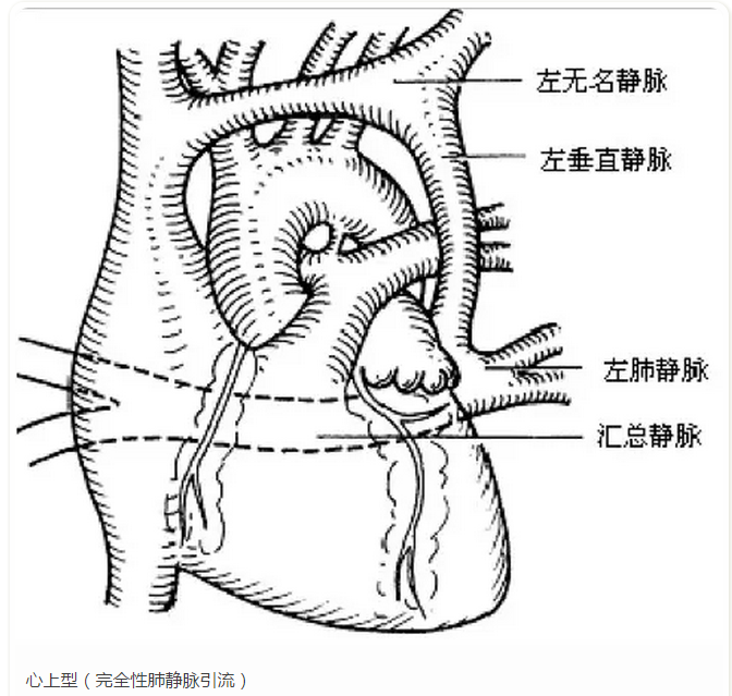 【先心病知识科普】什么是完全性肺静脉异位引流?
