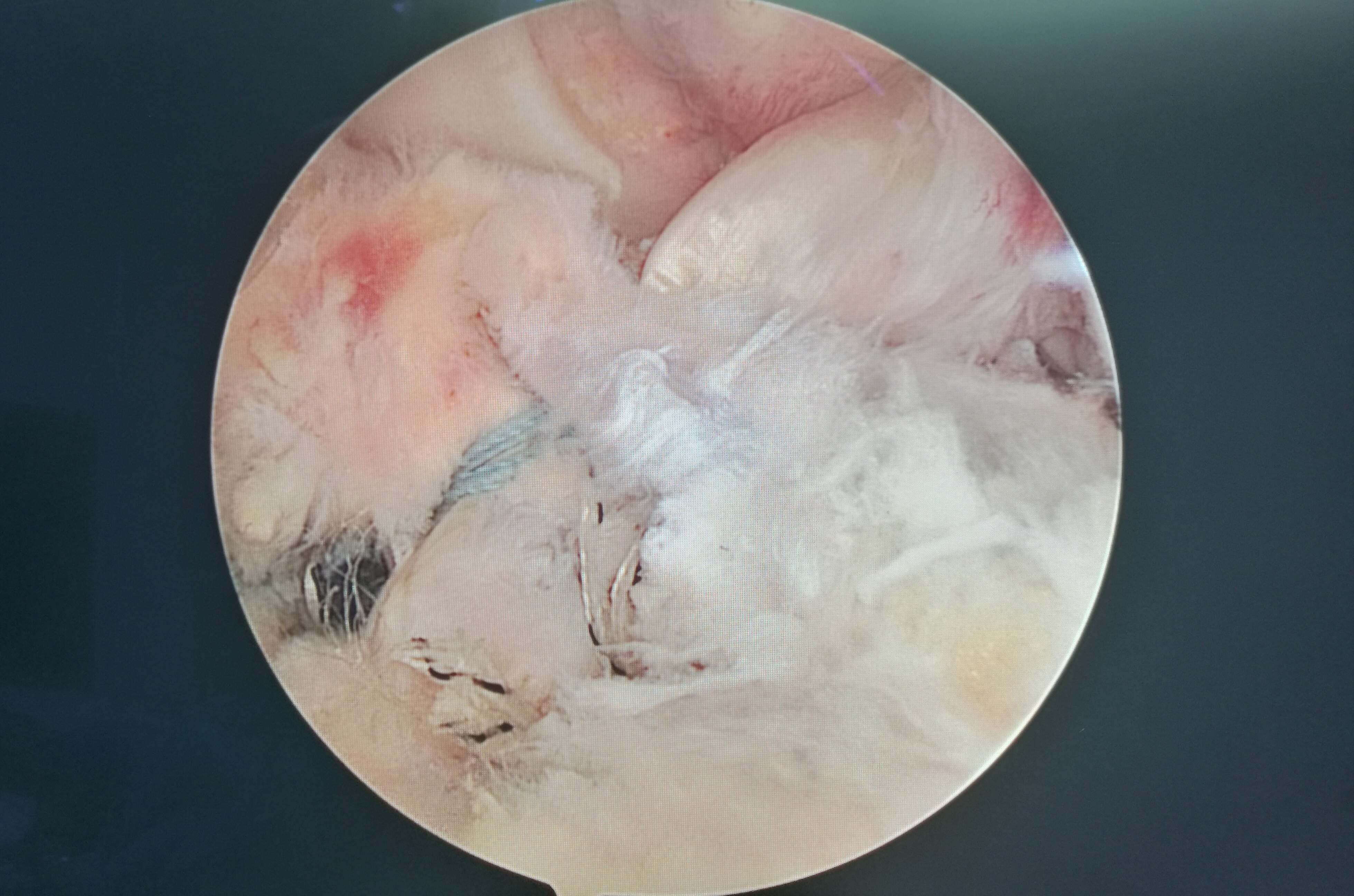 前交叉(十字)韧带撕脱骨折(髁间嵴)精彩手术 - 好大夫在线