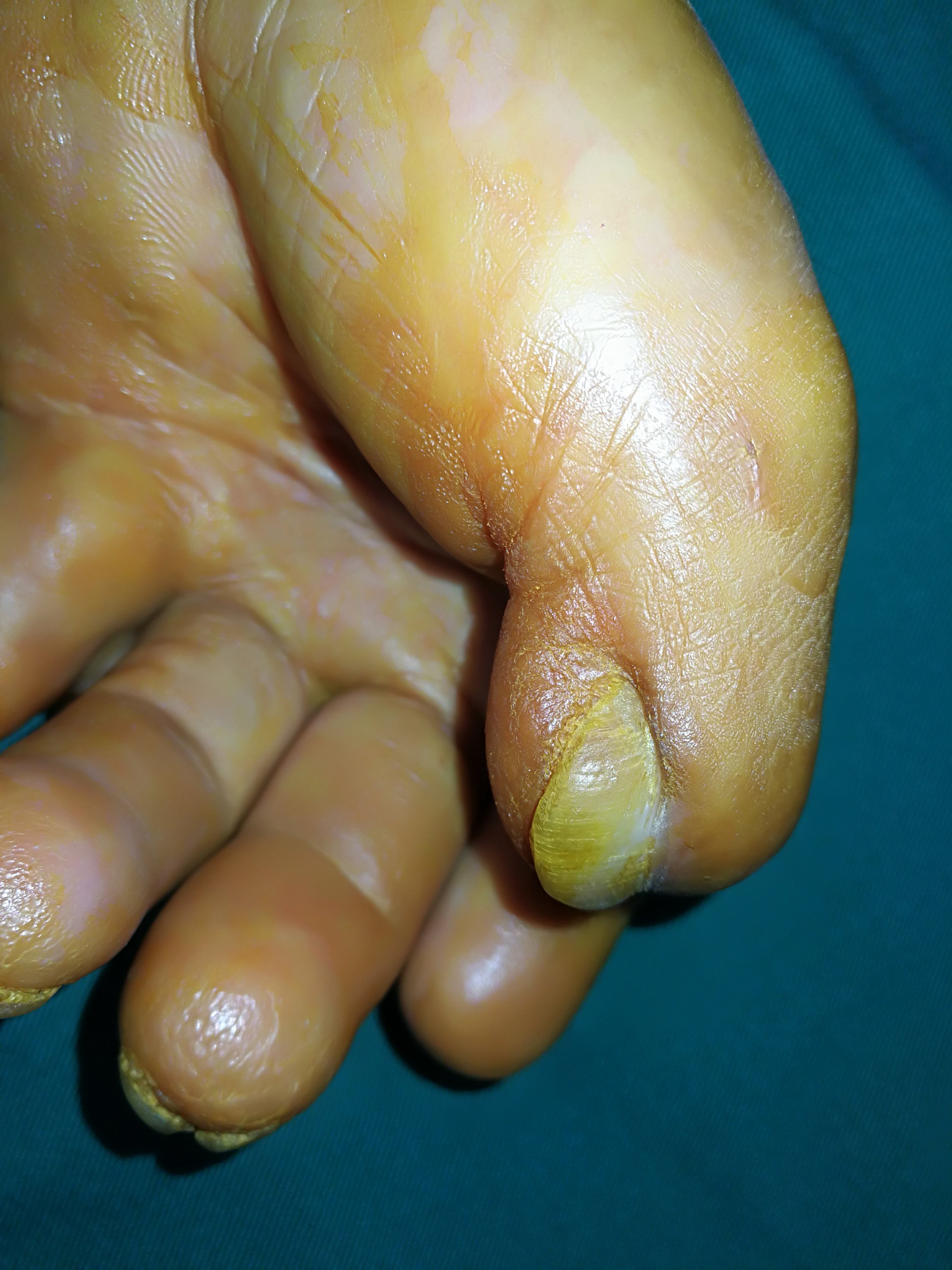 一个烧伤疤痕挛缩病例 - 好大夫在线