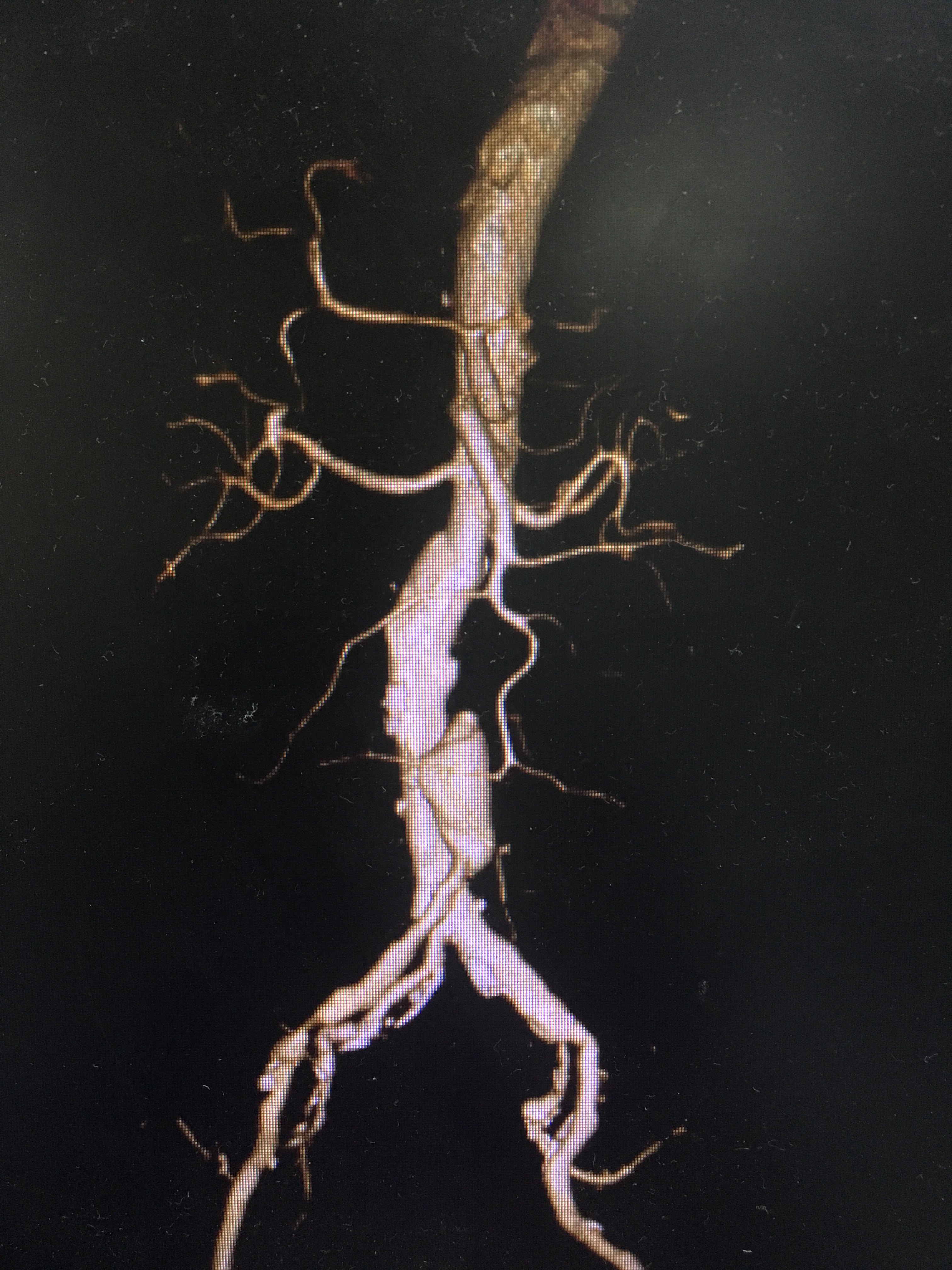 10.27造影发现腹主动脉瘤一例 - 好大夫在线