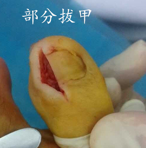 认识甲沟炎合理,采取恰当的治疗方案! - 好大夫在线