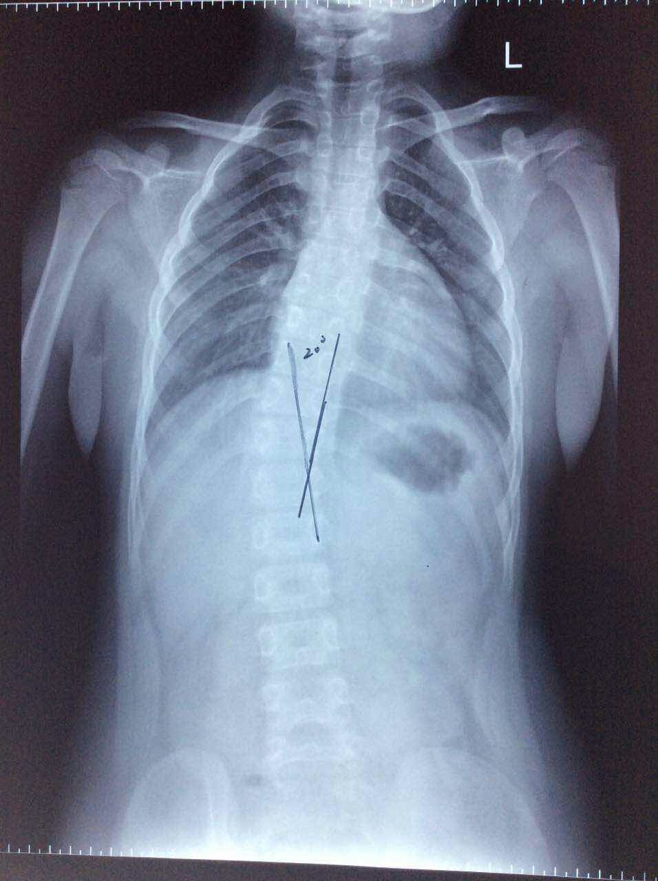 青春期脊柱弯曲矫正典型案例