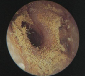 外耳道白色分泌物图片