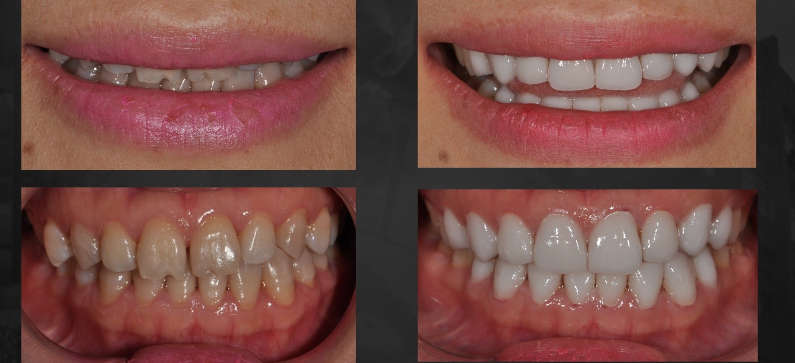 瓷贴面修复四环素牙治疗前后对比