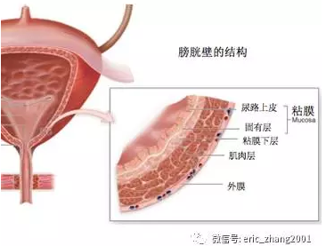 腺性膀胱炎 和普通膀胱炎不同 膀胱炎 膀胱炎