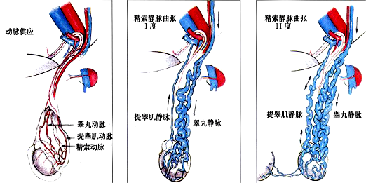 精索静脉曲张重度图片