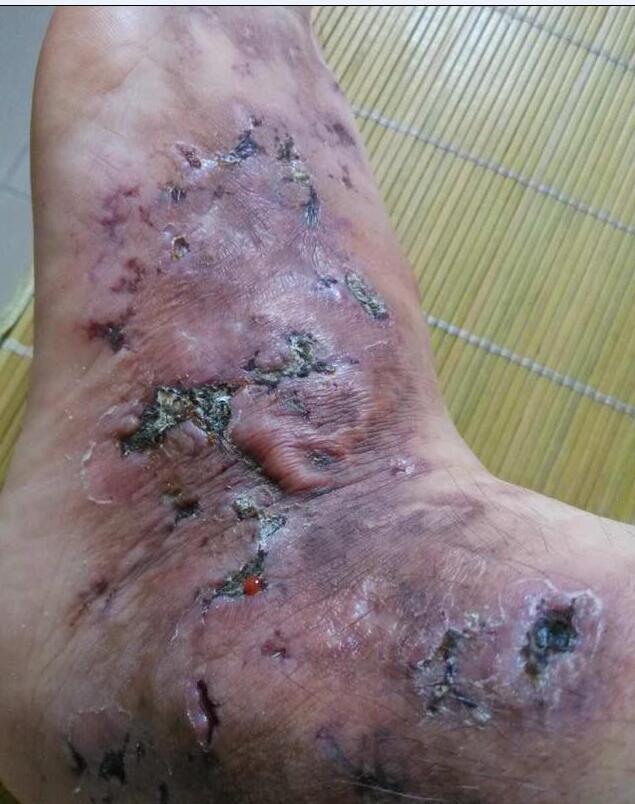 blanche)又稱節段性透明性血管炎(segmental hyalinizing vasculitis)