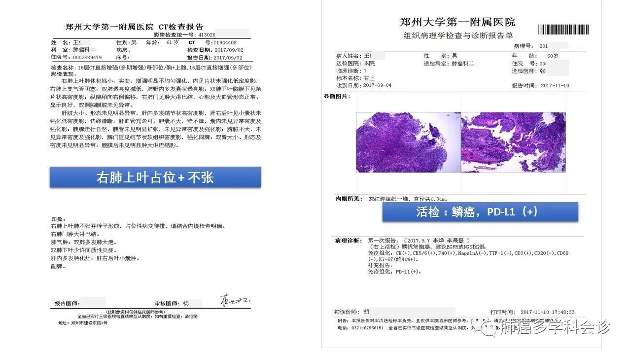 晚期非小细胞肺癌多学科会诊病例分享(1)