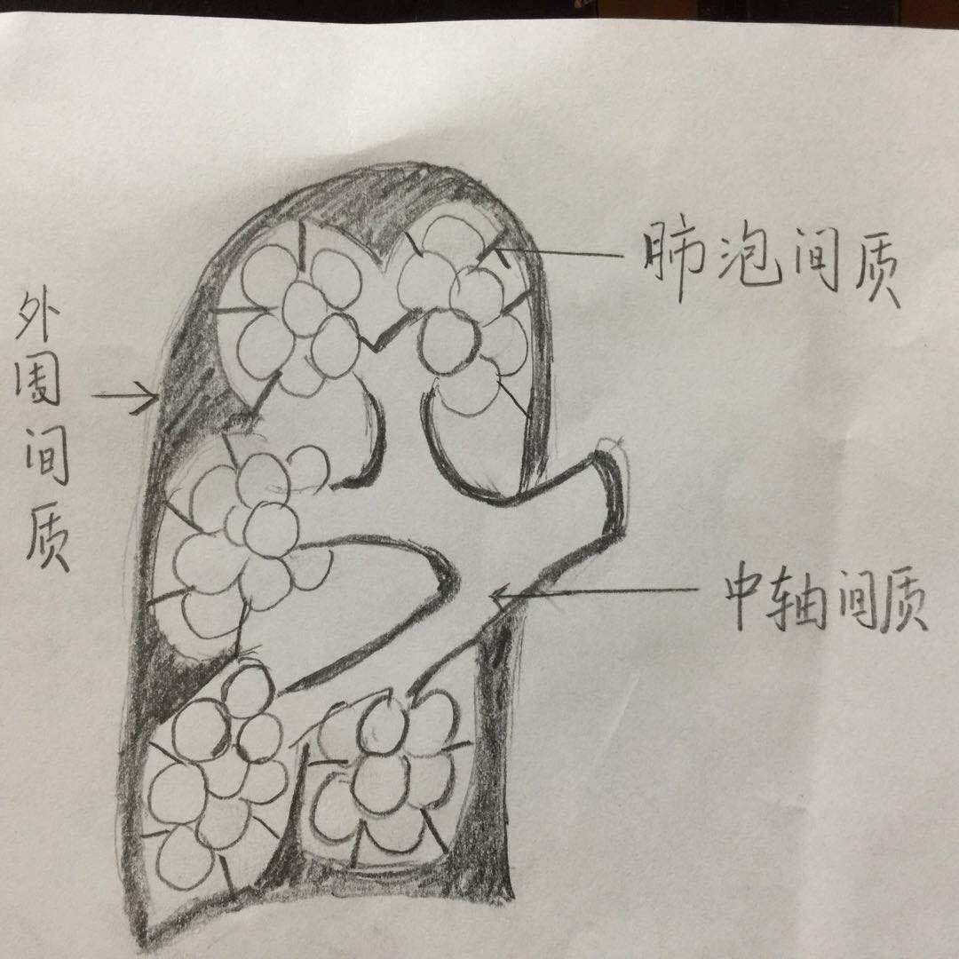 肺间质肺实质图解图片