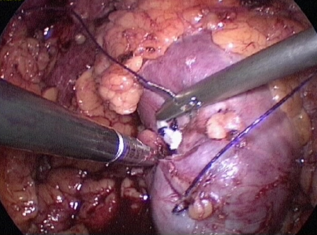 腹腔鏡腎部分切除術治療腎腫瘤--1