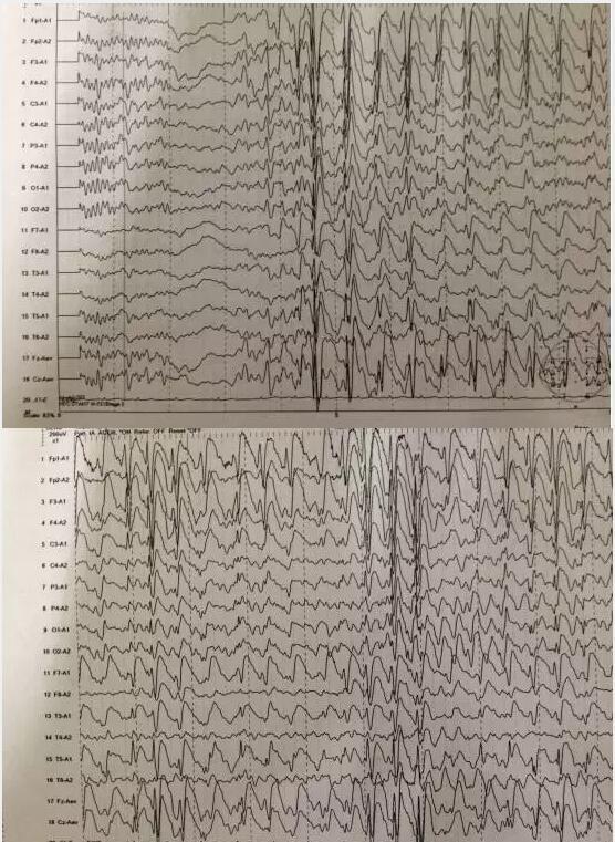 脑电图正常但是抽搐图片