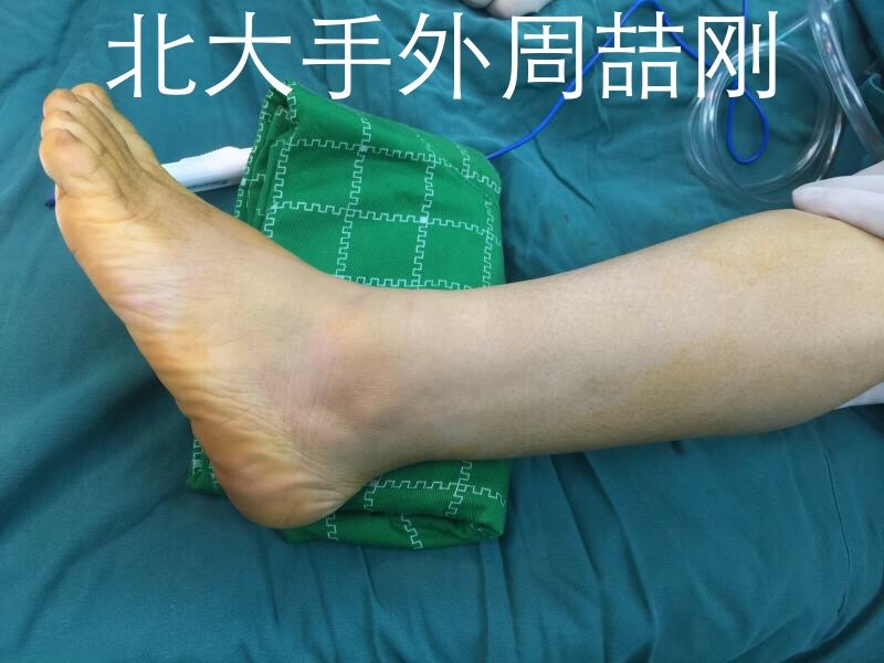 足血管 抗血管生成改善肿瘤微环境在肿瘤免疫治疗中的应用 新浪医药新闻 Amp Petmd Com 足血管 抗血管生成改善肿瘤微环境在肿瘤免疫治疗中的应用 新浪医药新闻 Amp Petmd Com