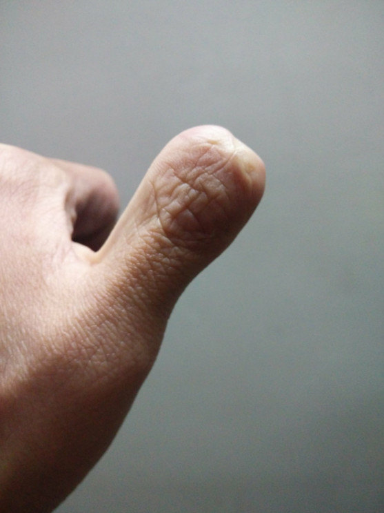 拇指再造手术效果好吗?(附图) - 好大夫在线