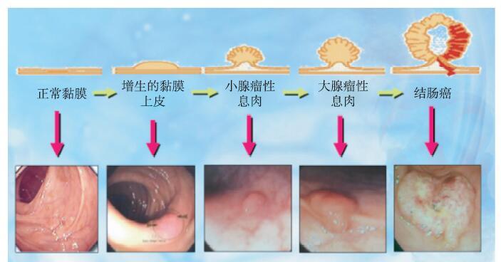 结直肠肿瘤筛查化繁为简关键词分层和肠镜