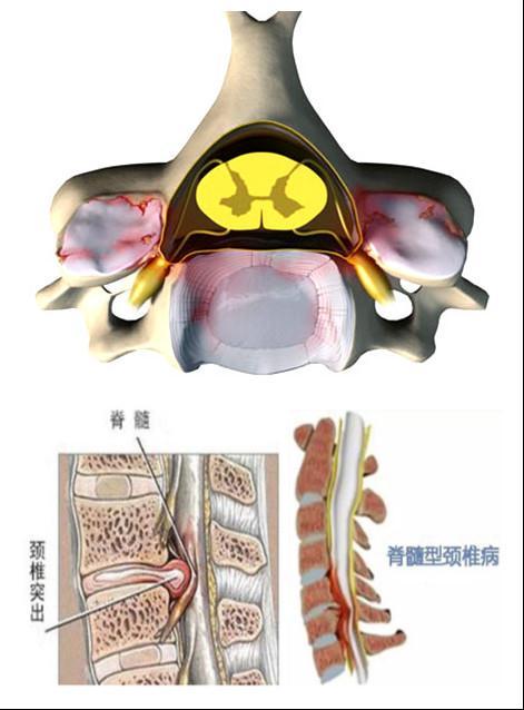 北美脊柱外科 手术是治愈脊髓型颈椎病唯一方法