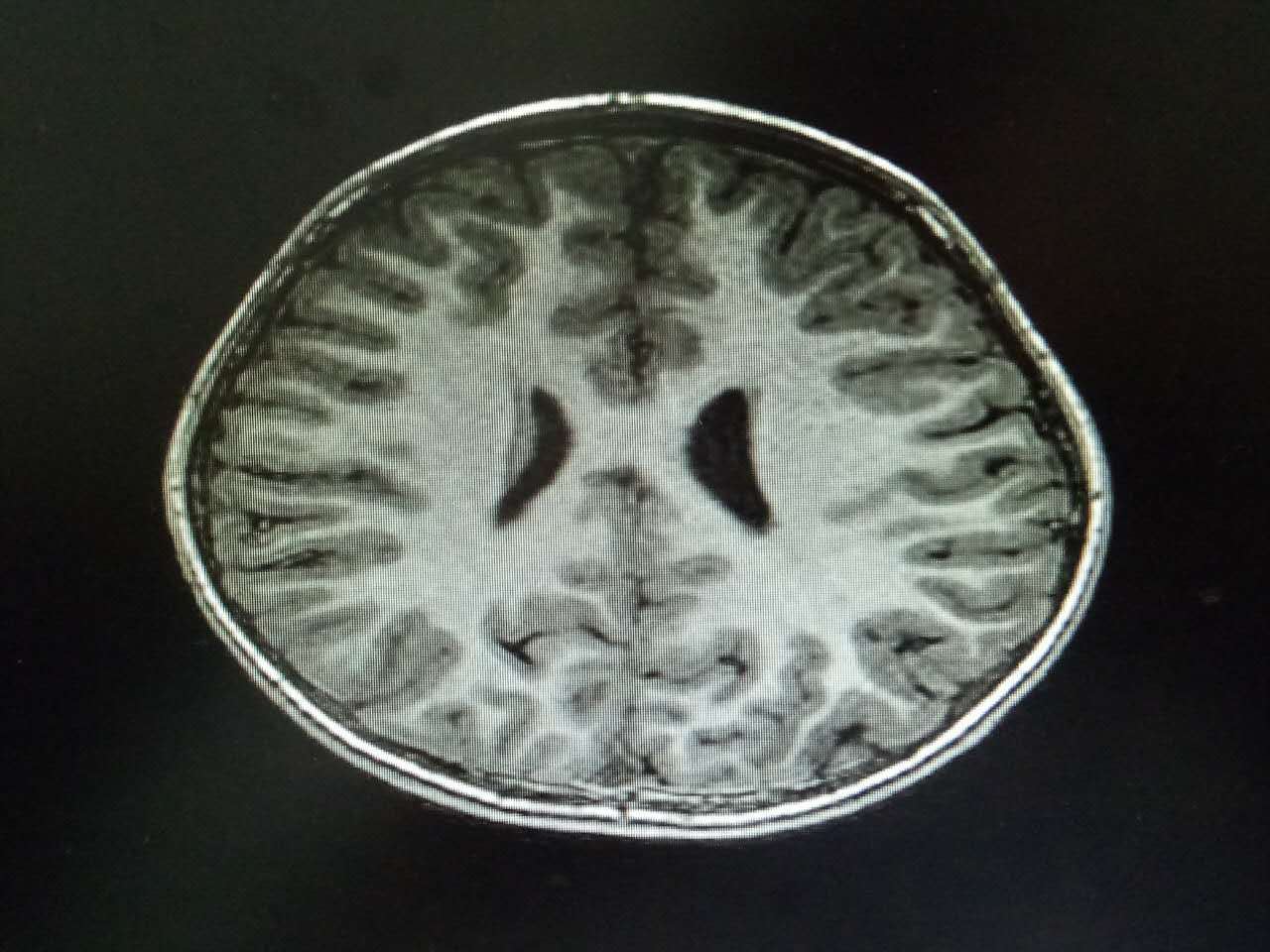 患兒薄層頭顱核磁共振掃描:大腦未見結構性異常