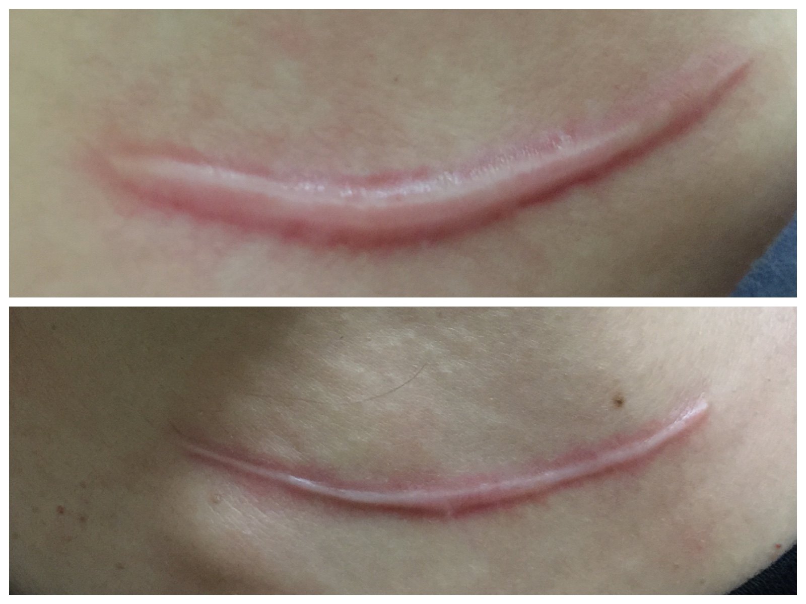 上图便是明显的颈部术后疤痕增生,虽然尽可能在缝合上面下功夫,但是有