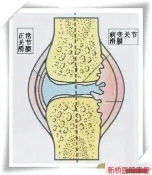 膝关节创伤性滑膜炎 