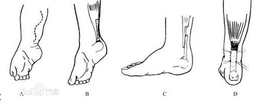 双足跟腱挛缩图片