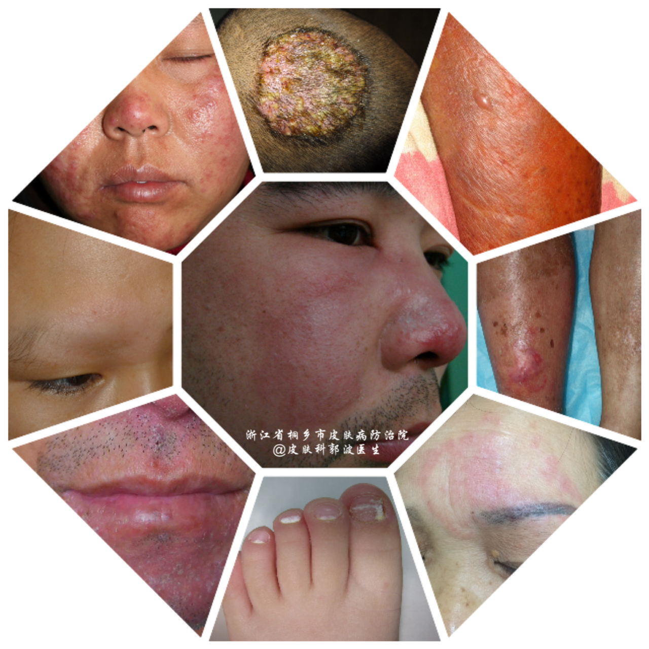 癣 是可以治愈的 脚气 症状 癣 是可以治愈的 脚气 症状