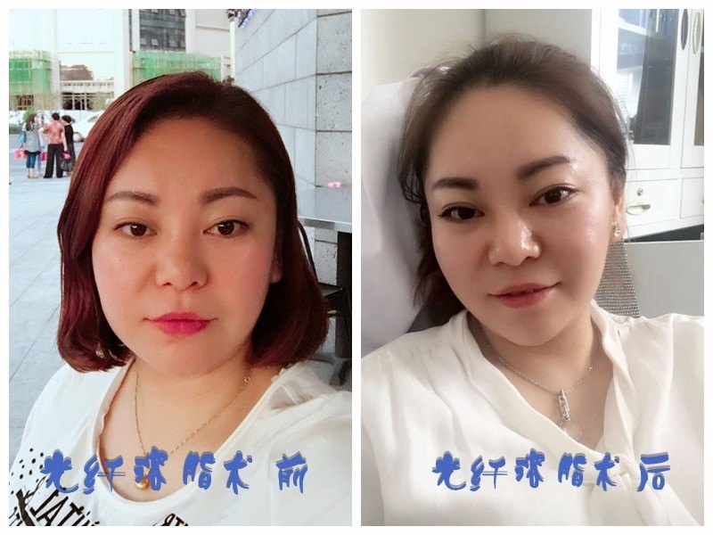 卢丙仑教授为你讲述--光纤溶脂如何治理你的大