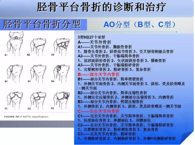 脛骨平臺骨折的診斷與治療技巧