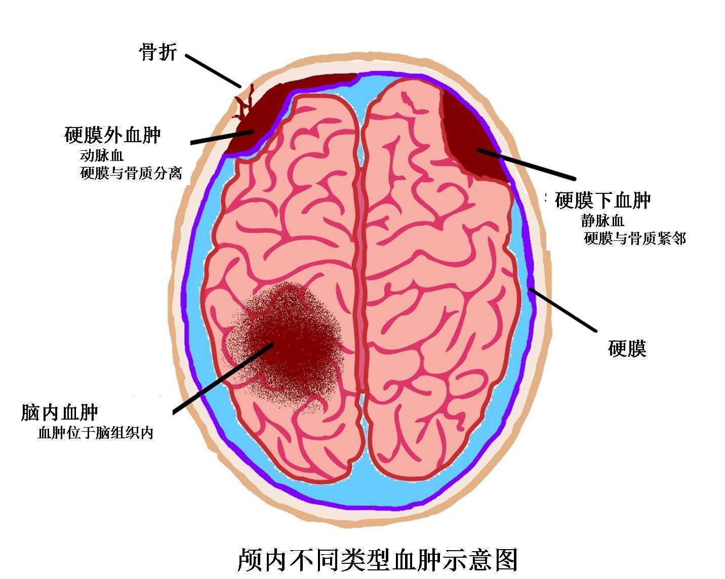 最常见的脑出血位置图图片