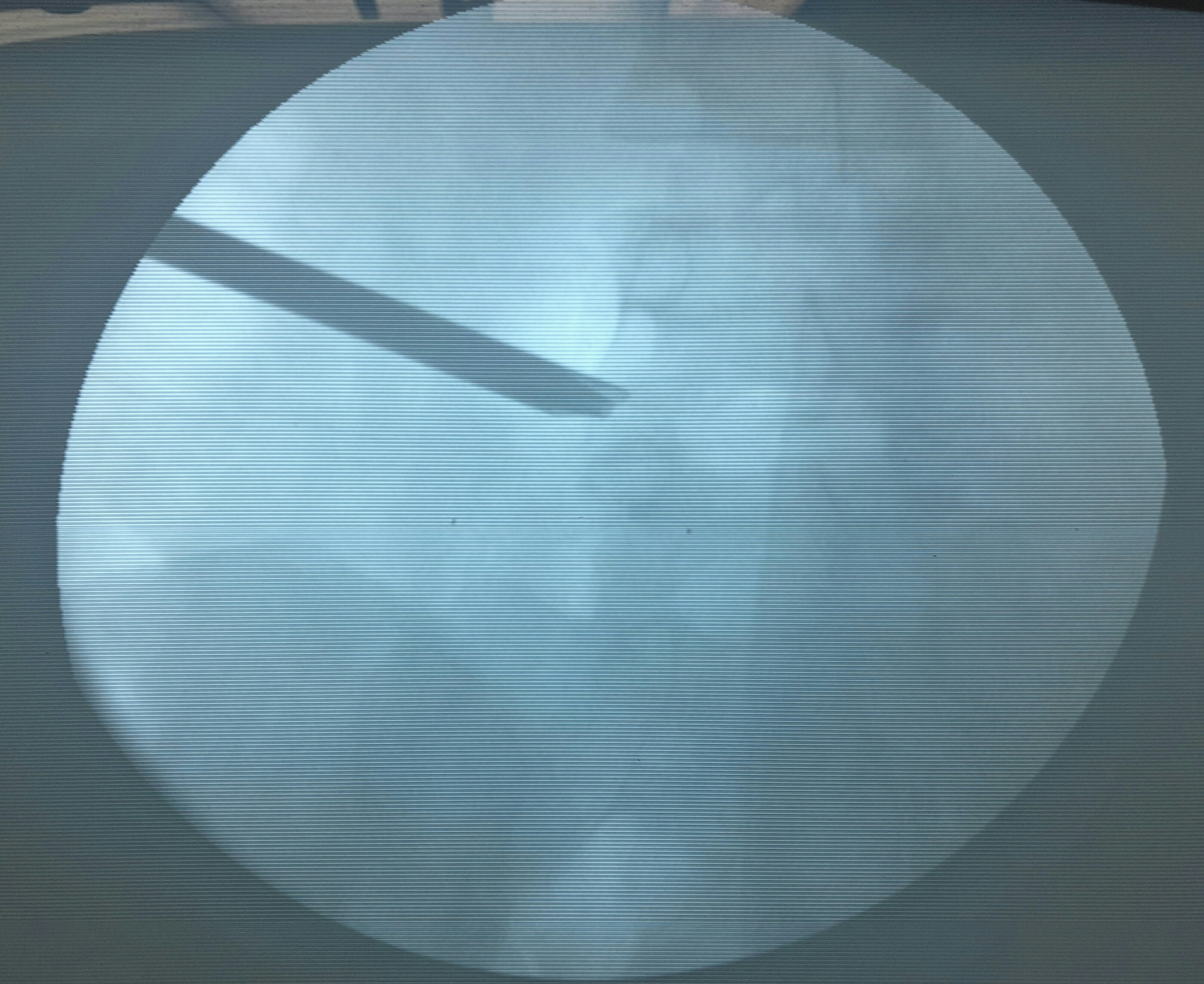 脊柱内镜翻修腰椎间盘突出症胶原酶溶核术后复