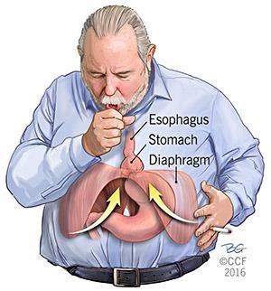 其發生是由維持胃及胃食管連接部的組織解剖異常或結構薄弱而引起