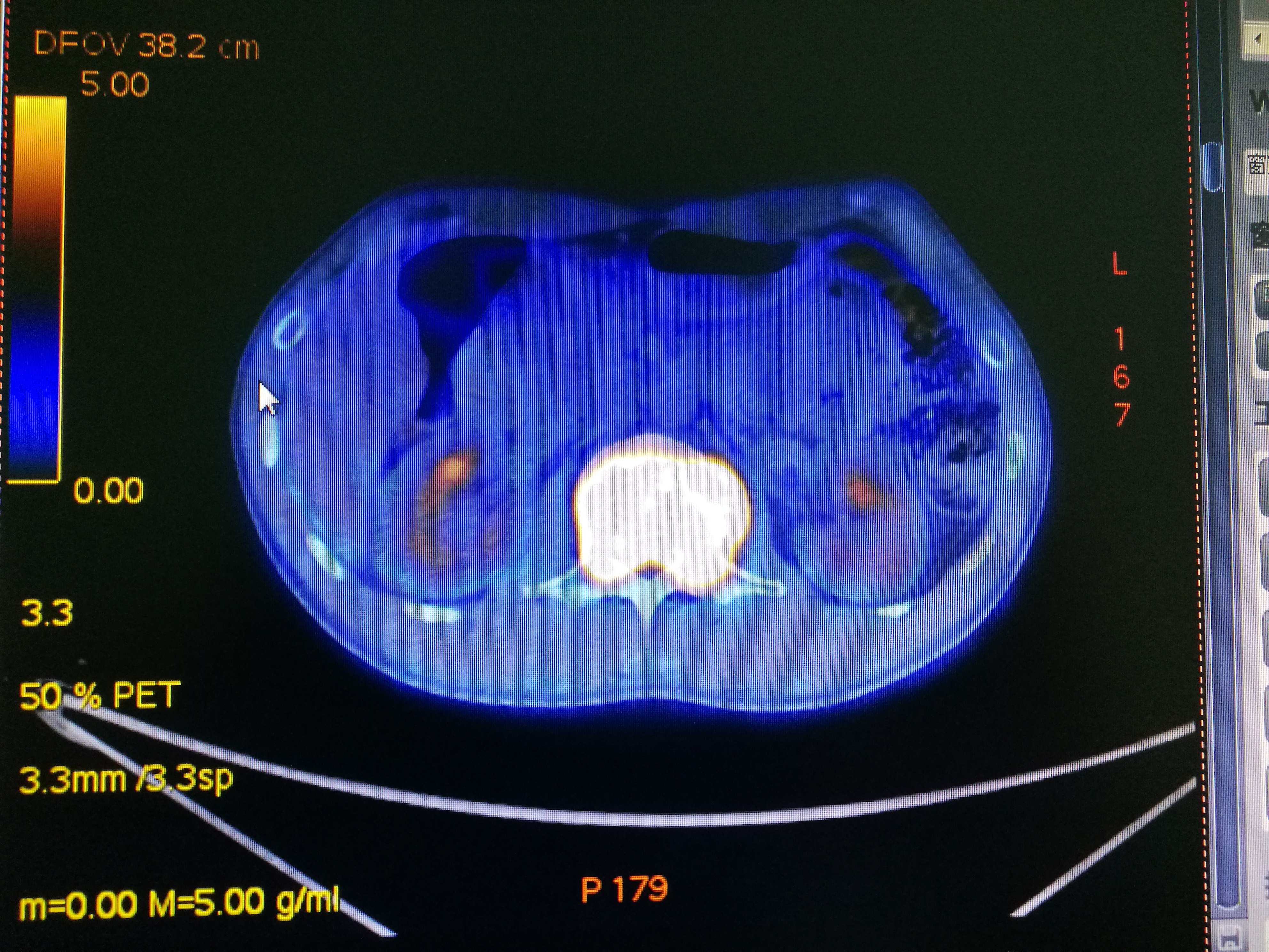 腰1椎体肿瘤(恶性),完整彻底切除 - 好大夫在线
