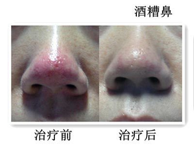 酒渣鼻玫瑰痤疮你的面子在哪里 好大夫在线 酒渣鼻玫瑰痤疮你的面子在哪里 好大夫在线