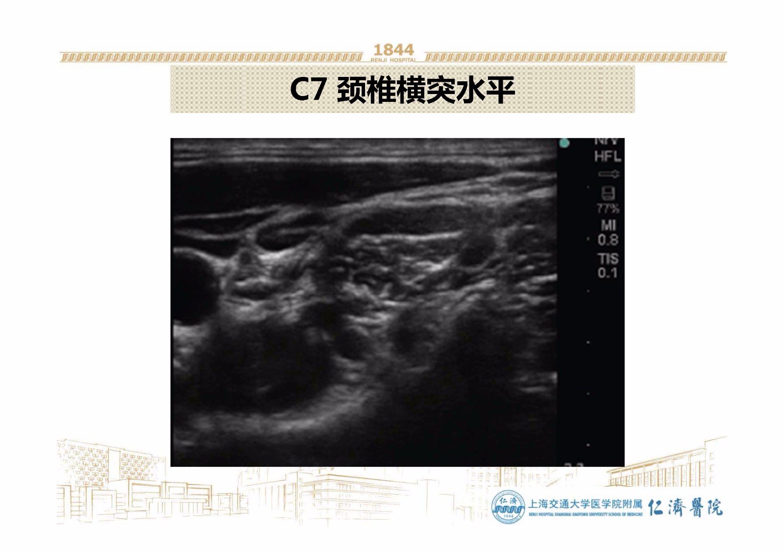 星状神经节阻滞超声图图片