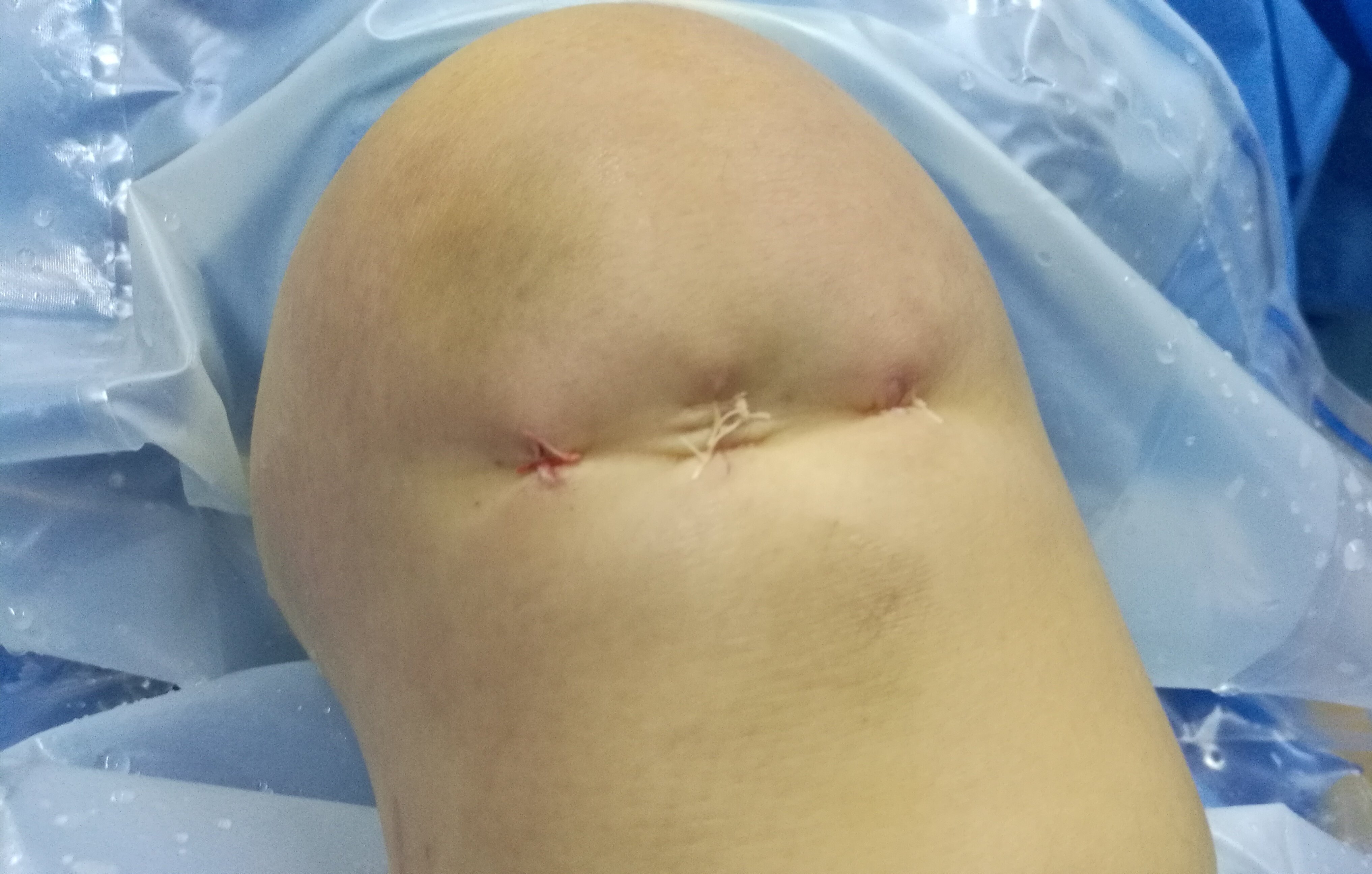 前交叉(十字)韧带撕脱骨折(髁间嵴)精彩手术 - 好大夫在线