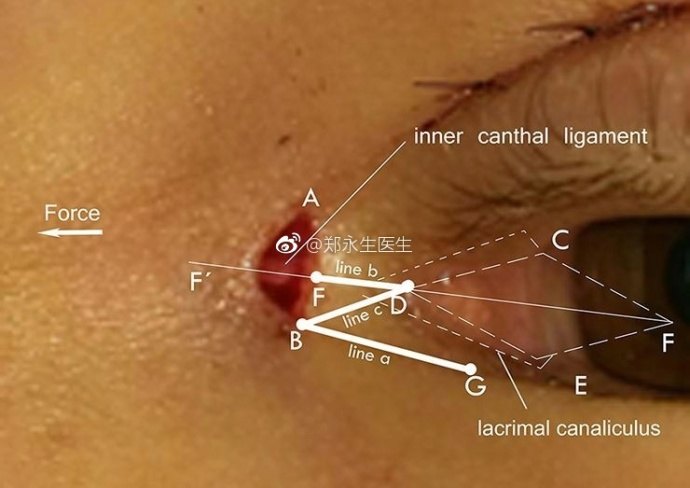 开眼角使用z瓣来减少张力性瘢痕 - 好大夫在线