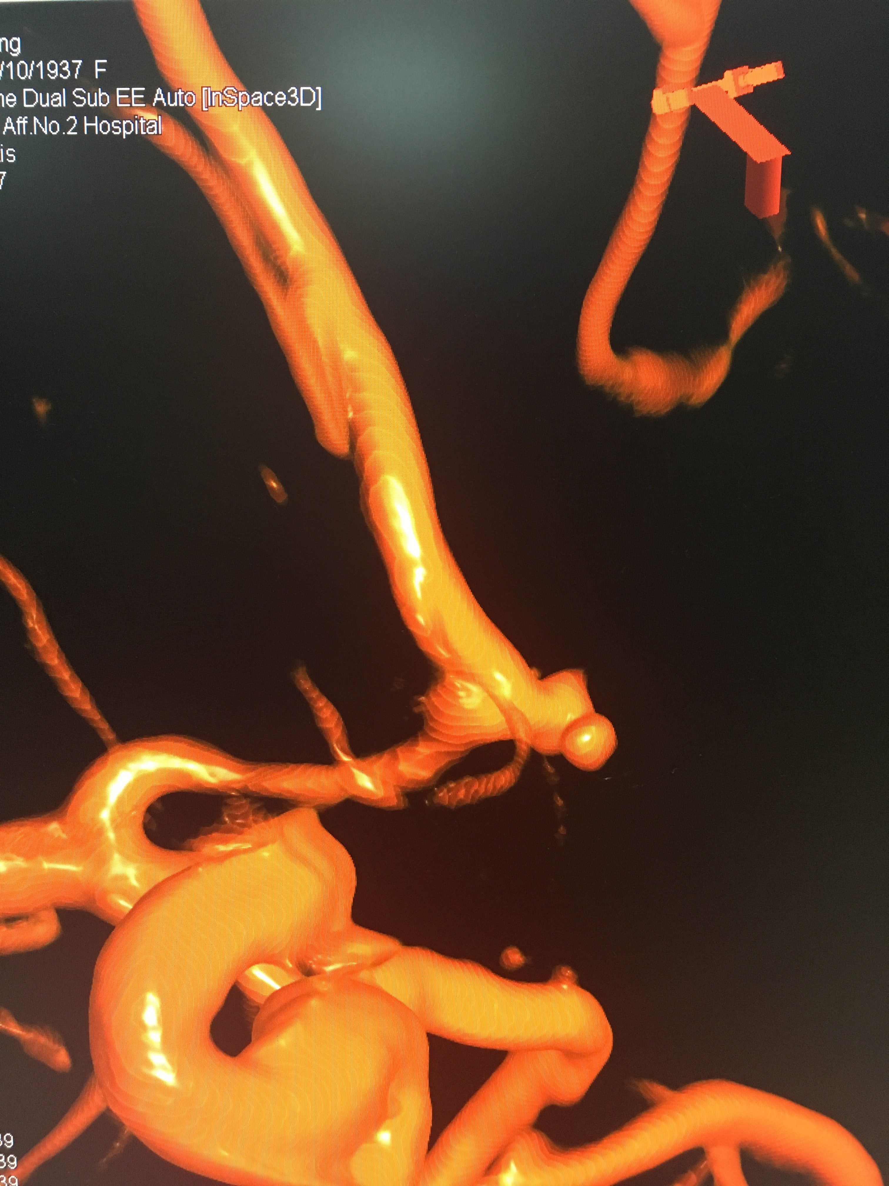 前交通小动脉瘤一例 - 好大夫在线