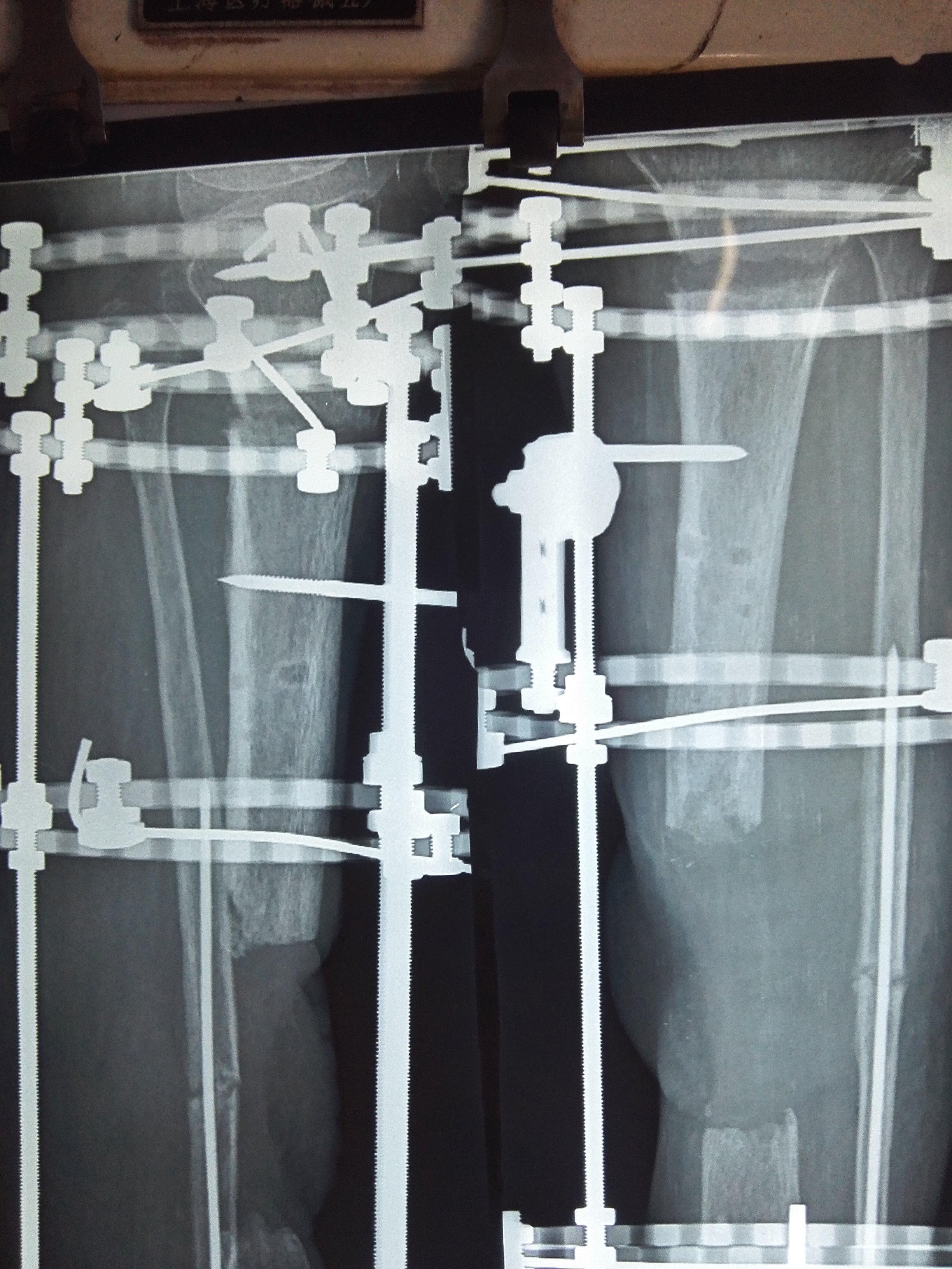 小腿骨缺损_骨搬移 - 好大夫在线