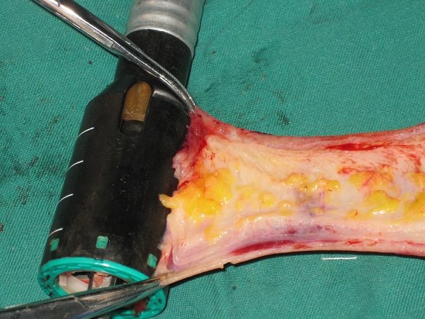 经肛吻合器直肠切除术(starr)治疗排便梗阻综合征 - 好大夫在线