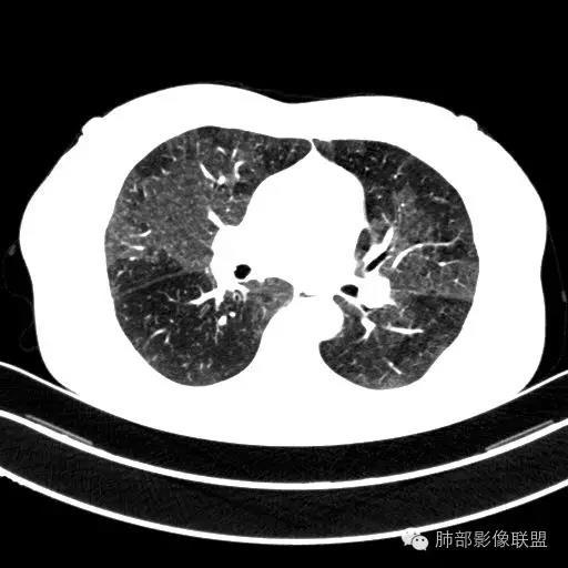 磨玻璃病变和马赛克病变的鉴别很重要,鉴别点在于用标准常规肺窗来