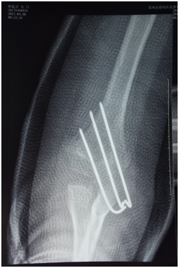 儿童肱骨髁上骨折闭合复位钢针内固定手术治疗典型病例 
