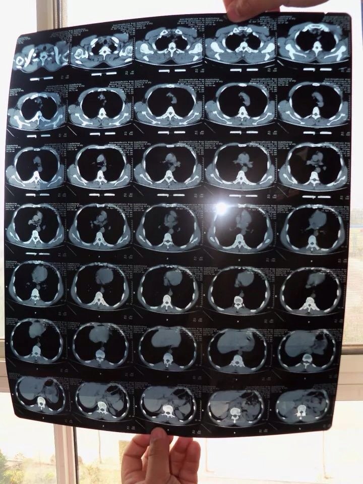 相对于x光片来说,ct筛查对肺癌的早期诊断要优于胸部x光片